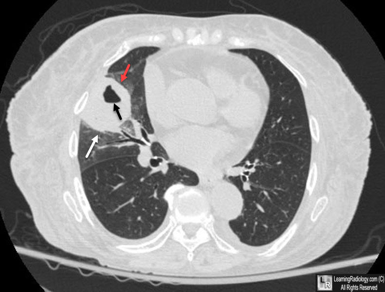 Lung Abscess